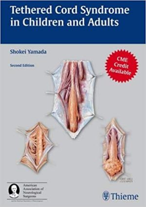 Tethered Cord Syndrome in Children and Adults