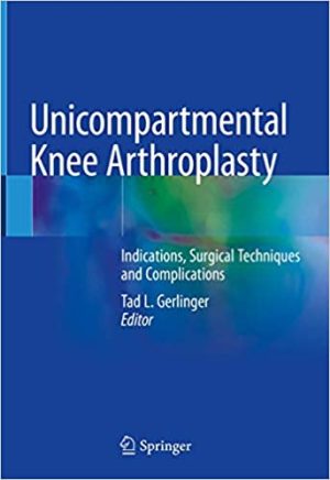 Unicompartmental Knee Arthroplasty Indications Surgical Techniques and Complications