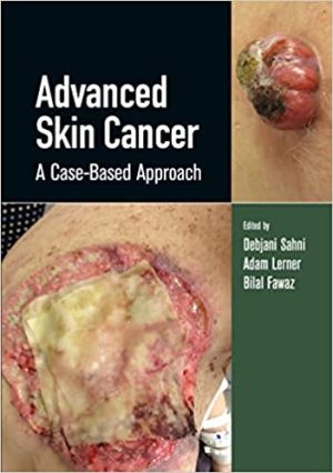 Advanced Skin Cancer A Case Based Approach