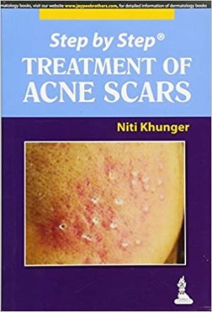 Step by Step Treatment of Acne Scars