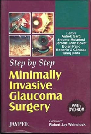 Step by Step Minimally Invasive Cataract Surgery