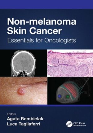 Non Melanoma Skin Cancer Essentials for Oncologists